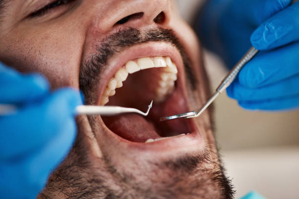 Best Emergency Dentist for Lost Fillings or Crowns in Bellmore, NY
